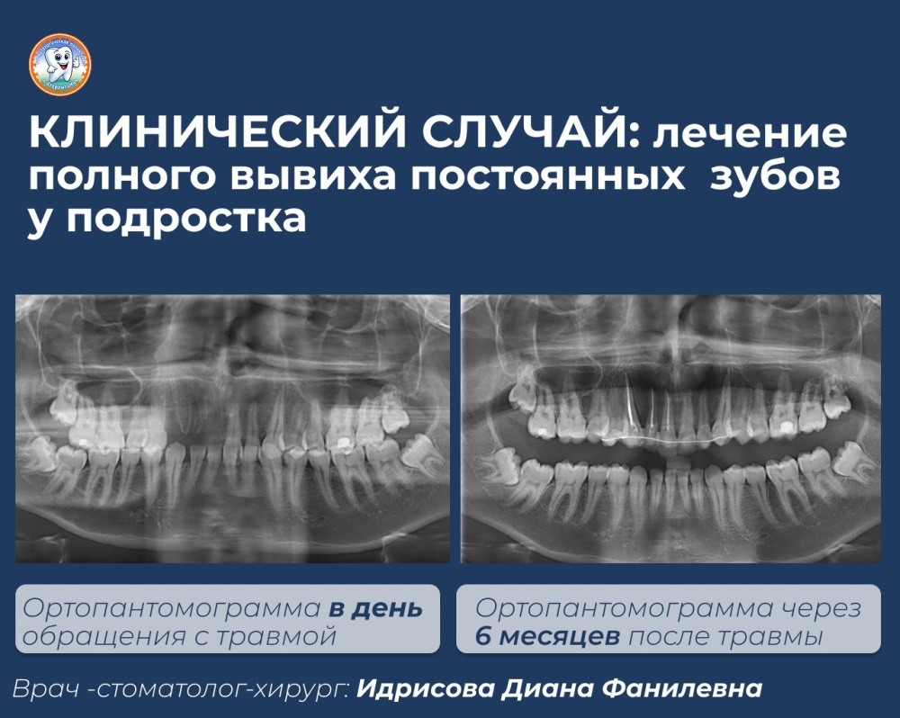Клинический случай: лечение полного вывиха постоянных зубов у подростка